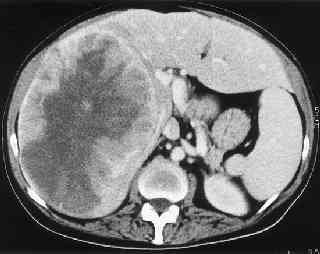 CT_liver_met.jpg (9324 bytes)