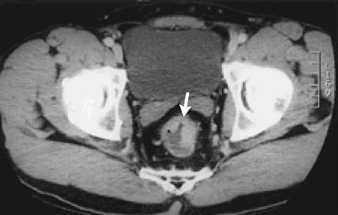 rectal cancer on ct