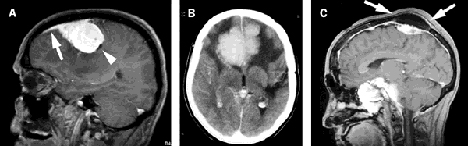MRI_meningioma_2_utd.jpg (51261 bytes)