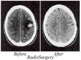RS_before_after.jpg  (11044 bytes)