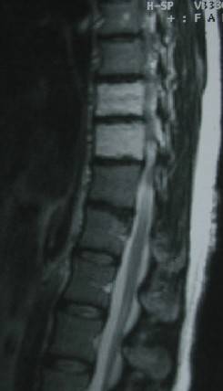 What is the typical progression of malignant spinal hemangiomas?