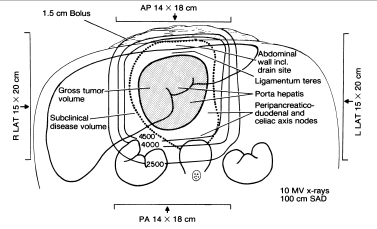 biliary_port.gif (16004 bytes)