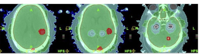 brain_met_ghia_807.jpg (56641 bytes)
