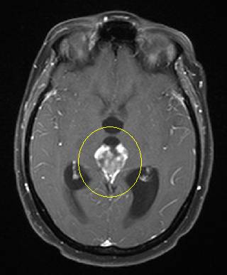brain_met_midline.jpg (15180 bytes)