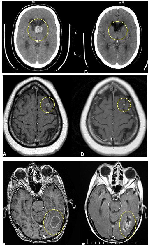 brain_mets_GK_long_term_Pitt.jpg (76494 bytes)