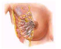 breast2.jpg (3346 bytes)