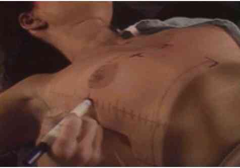breast_marking.jpg (7466 bytes)
