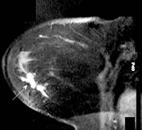 breast_mri2.jpg (10586 bytes)
