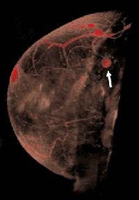 breast_mri_1.jpg (7735 bytes)