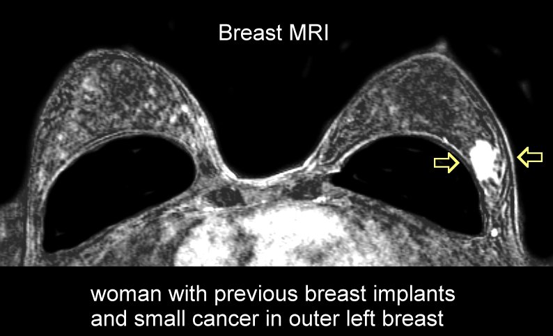 Mri Breast Imaging 105