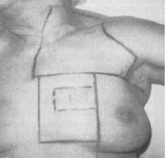 breast_port_supraclav_perez.jpg (15261 bytes)