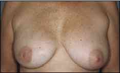 breast_recon1.jpg (3053 bytes)