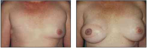 breast_recon1.jpg (3053 bytes)