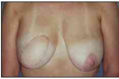 breast_recon3.jpg (3275 bytes)