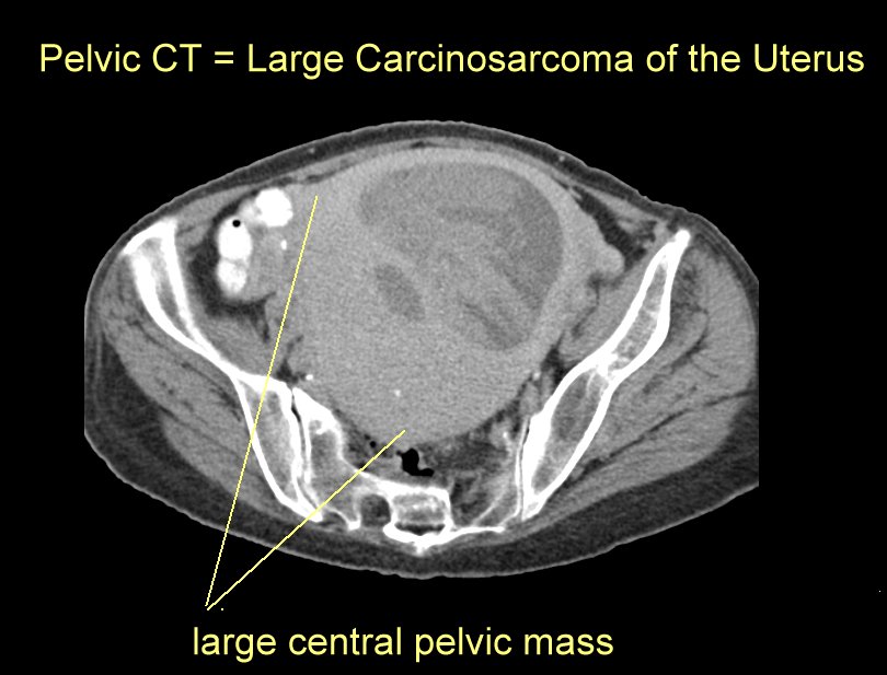 endometrial cancer on ct scan