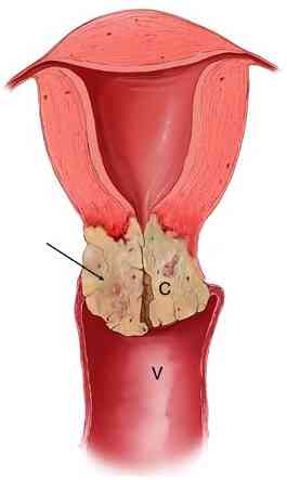 cervical_expansion.jpg (7763 bytes)