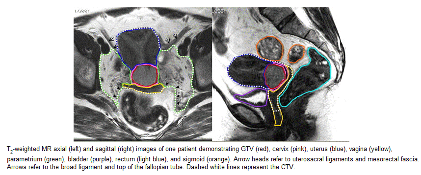 Mri Cervix