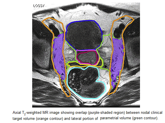 Mri Cervix