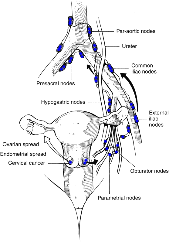 Cancer Of The Cervix And Node Spread