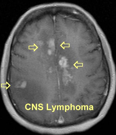 Brain (CNS) Lymphoma