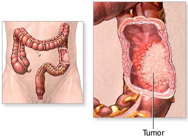 colon_cancer_adam.jpg (22938 bytes)