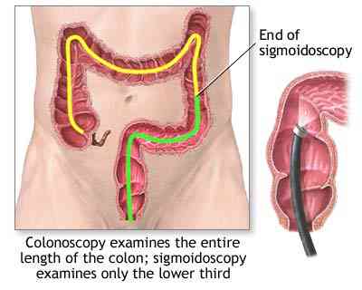 colonoscopy_adam.jpg (13940 bytes)