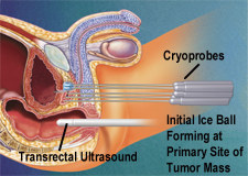 cryosurgery.jpg (19611 bytes)