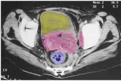 ct_cervix_color.jpg (11836 bytes)