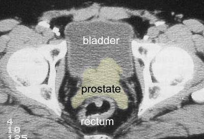 ct_prostate_tobias.jpg (21165 bytes)