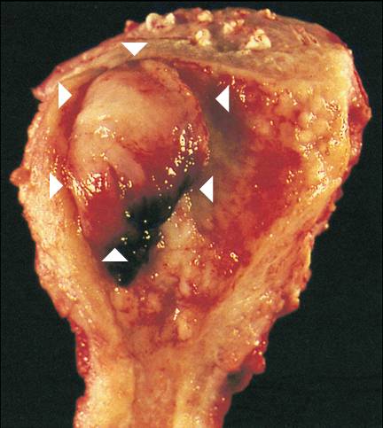 endomet_gross_utd_207.jpg (33427 bytes)