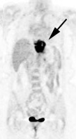 esophagus_pet_large_CT_mass.jpg (7281 bytes)