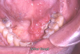 Mouth Cancer Sore