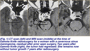 gamma_meningioma.gif (53213 bytes)