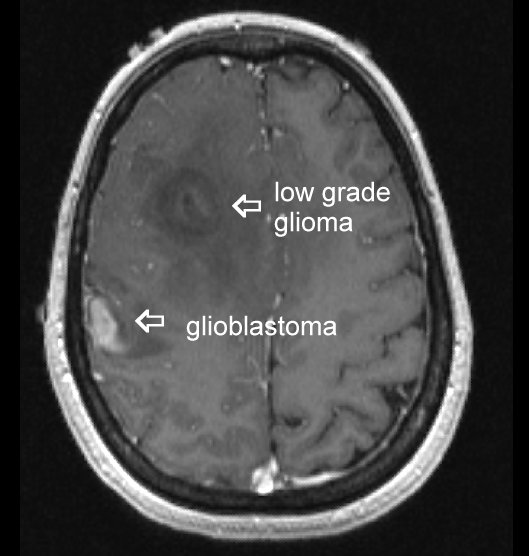 low grade glioma and glioblastoma