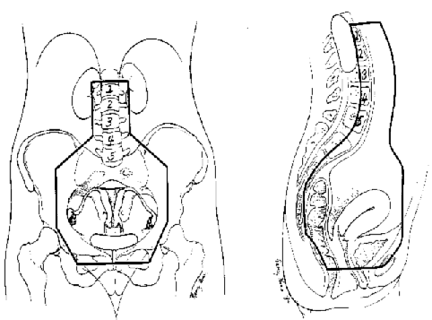 Radiation Fields for Gyn Cancers diagram of bowel 