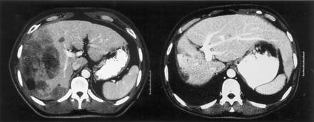hepatic_xrt_jco.jpg (13440 bytes)