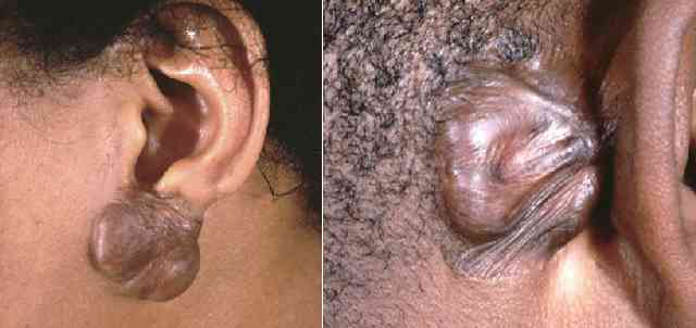 keloid_ear_images.jpg (17334 bytes)
