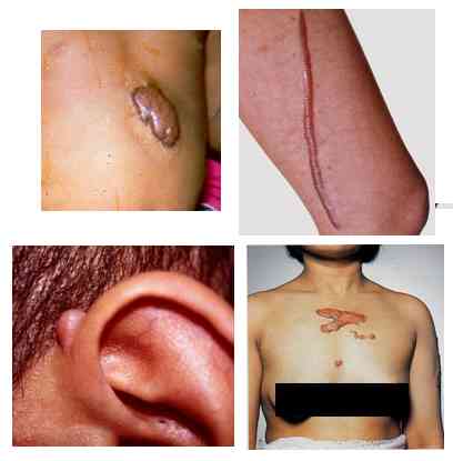 keloid_more.jpg (13372 bytes)
