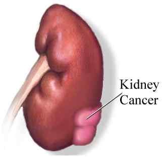 kidney_cancer.jpg (6300 bytes)