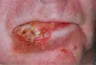 lip_cancer5.jpg (2476 bytes)