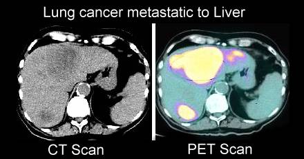 Is it possible to have a PET scan done and still have lung cancer?