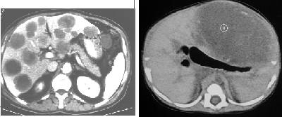 liver_mets_comparisons.jpg (13796 bytes)