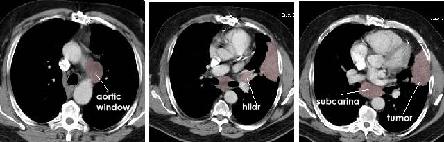 lung_typical_nodes_bmc.jpg (28853 bytes)