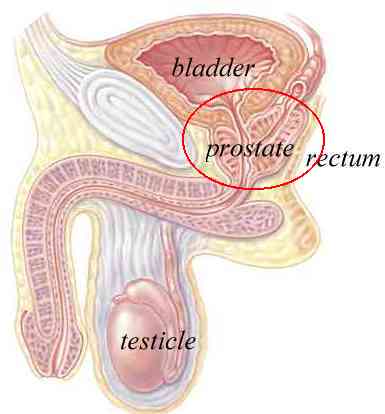 What are some side effects of prostrate radiation?