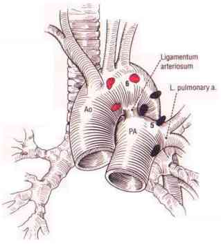 mediastinum2a.jpg (10841 bytes)