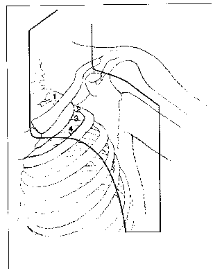 melanoma_ballo1.gif (3791 bytes)