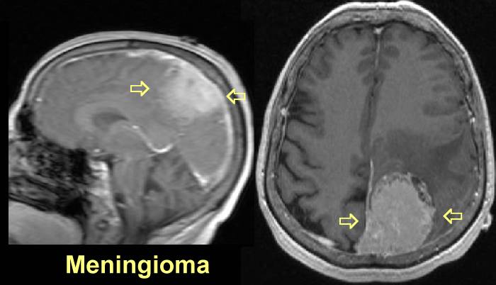 meningioma_bmc_jan_2007.jpg (32618 bytes)