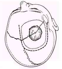 meningioma_surgery.jpg (6237 bytes)