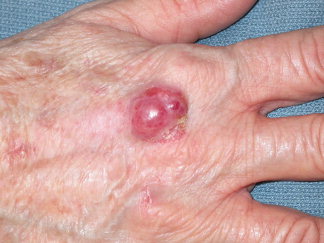 Merkel Cell Carcinoma - Pictures, Treatment, Symptoms ...