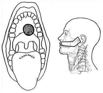 minor_salivary_port.jpg (11363 bytes)
